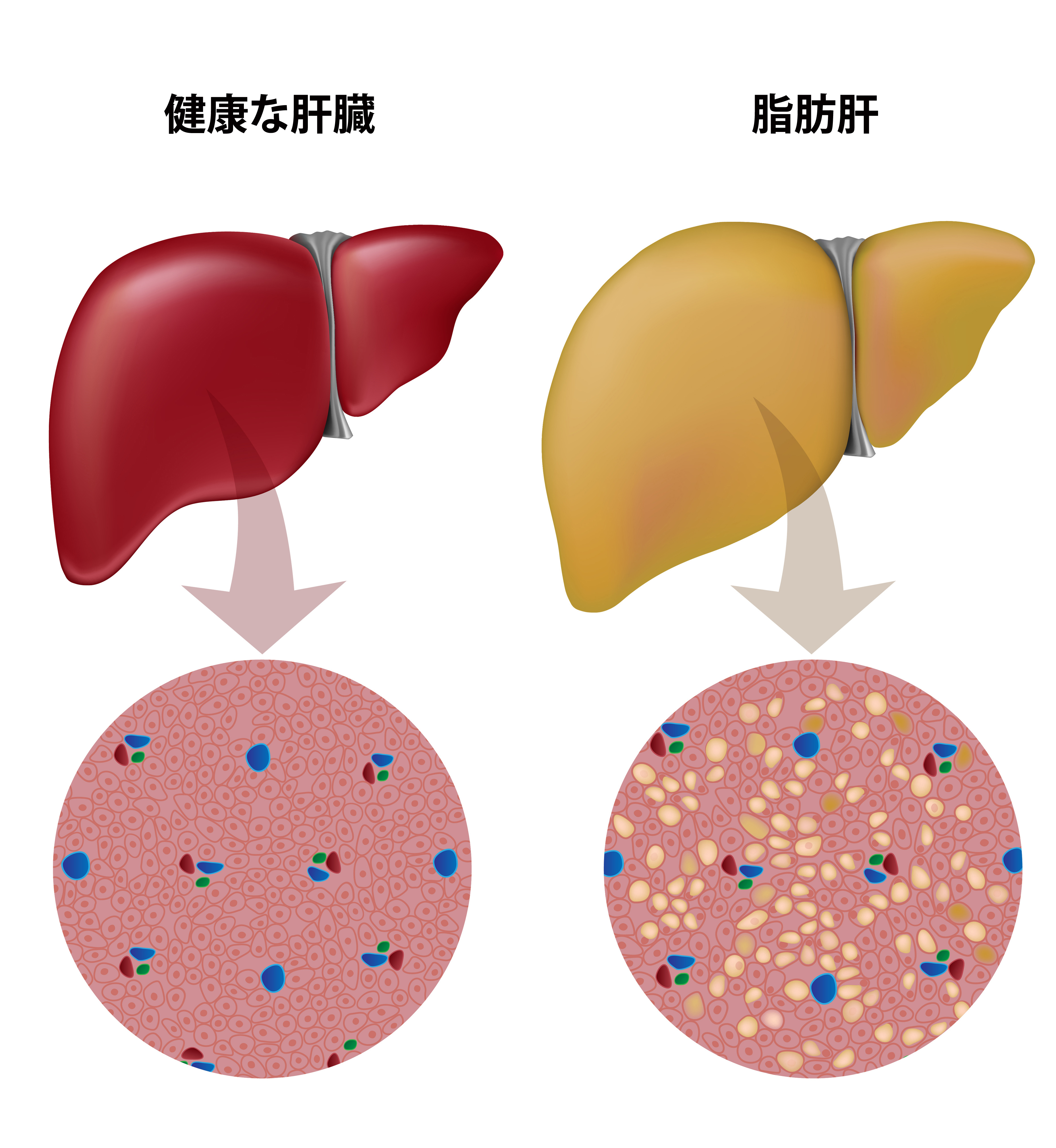 は 脂肪 肝 と